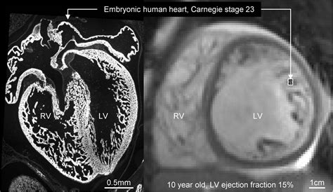 non compaction cardiomyopathy guidelines